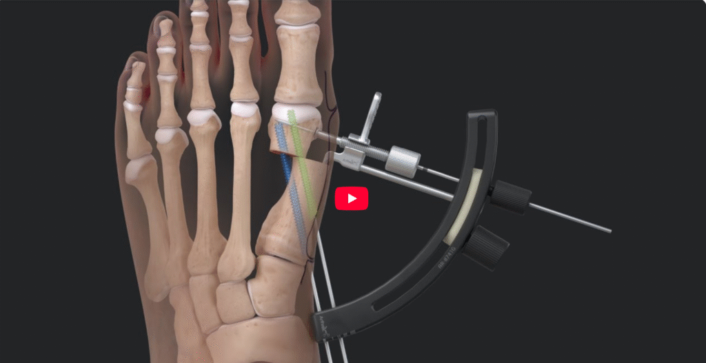 Chirurgie du hallux valgus à Montréal et Terrebonne: chirurgie mini-invasive (MIS) ou technique traditionnelle?